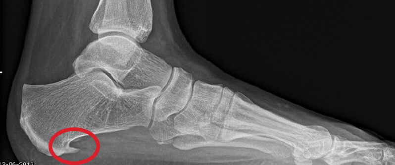 Hielspoor op röntgenfoto Hielspoor op röntgenfoto